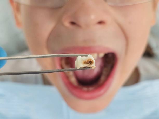 Best Knocked-Out Tooth (Avulsed Tooth) Treatment in Belpre, OH